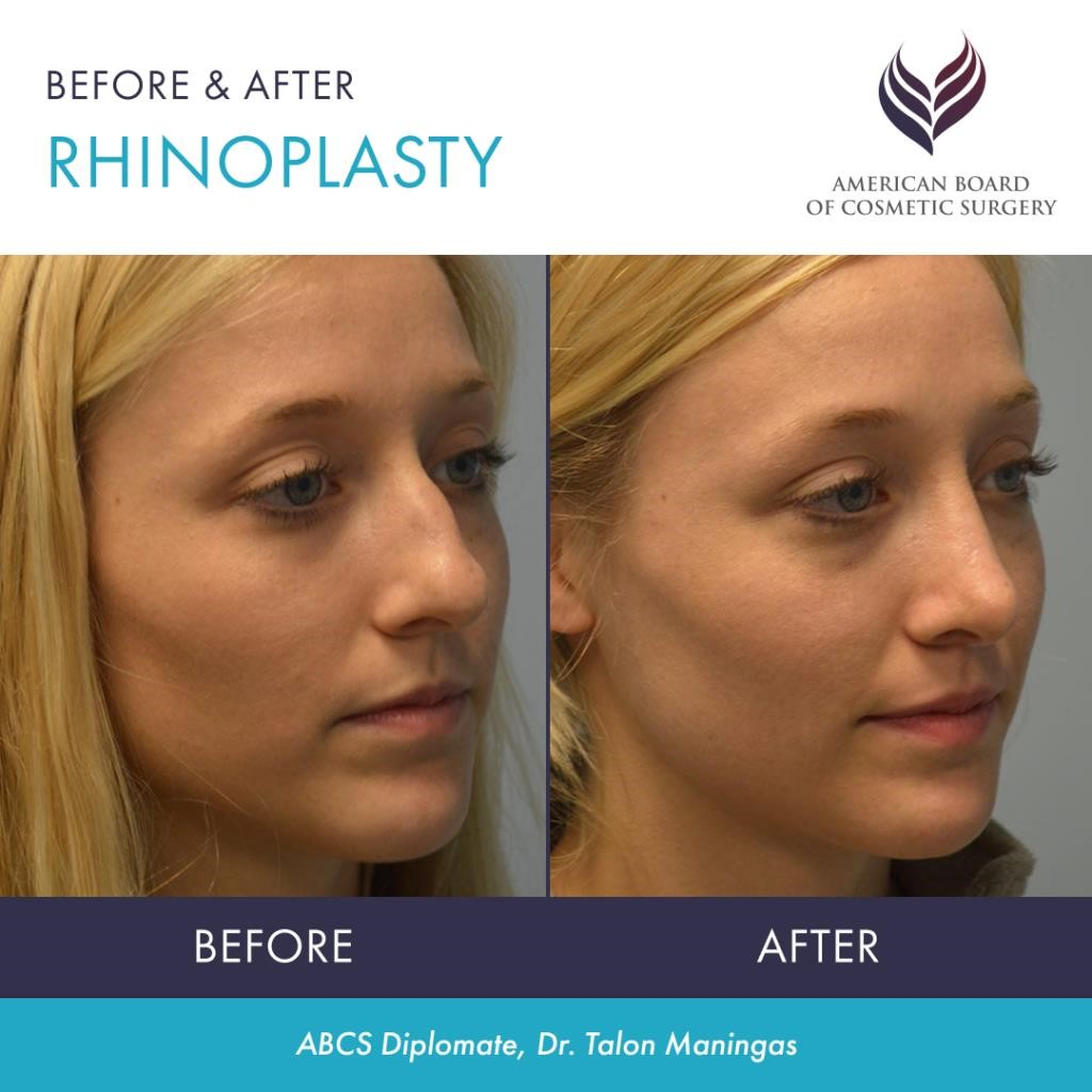 revision rhinoplasty experts