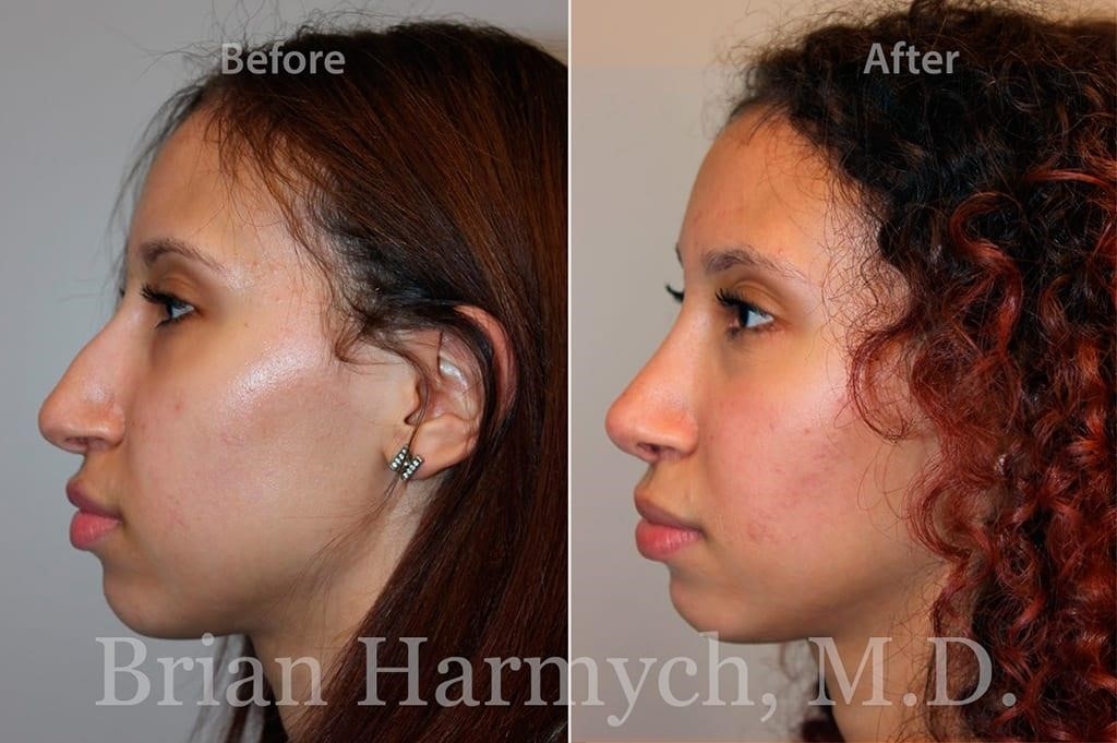 revision rhinoplasty experts